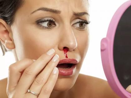 nose bleeding cure: causes and reasons of nose bleeding or nakseer, medical treatment and home remedies for nose bleeding in Hindi | नकसीर फूटने का इलाज : नकसीर का घरेलू इलाज करने के लिए अपनाएं ये 8 आसान तरीके