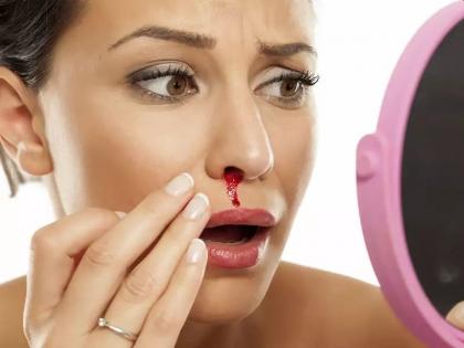 nose bleeding cure: causes and reasons of nose bleeding or nakseer, medical treatment and home remedies for nose bleeding in Hindi | नकसीर फूटने का इलाज : नकसीर का घरेलू इलाज करने के लिए अपनाएं ये 8 आसान तरीके nose bleeding cure: causes and reasons of nose bleeding or nakseer, medical treatment and home remedies for nose bleeding in Hindi | नकसीर फूटने का इलाज : नकसीर का घरेलू इलाज करने के लिए अपनाएं ये 8 आसान तरीके