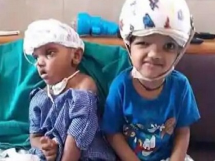 One child Kalia of Odisha twin separated by Craniopagus surgery dies in cuttack | तीन साल पहले सर्जरी से अलग किए गए सिर से जुड़े दो बच्चों में से एक की मौत, भारत में पहली बार किया गया था ऐसा ऑपरेशन