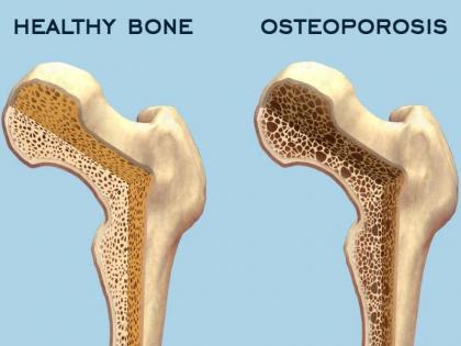 Osteoporosis symptoms in Hindi: what is Osteoporosis, symptoms, risk factors, medical treatment, prevention tips and diet plan in Hindi | Osteoporosis: जानिये हड्डियों की बीमारी ऑस्टियोपोरोसिस के 3 गंभीर लक्षण, किसे है ज्यादा खतरा, बचाव और डाइट प्लान