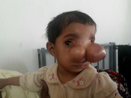 Pakisath girl Asiya Manghrio nose look like elephant trunk | बच्ची की नाक बनी हाथी की सूंड, लोगों ने कहा- शैतान का रूप है यह लड़की