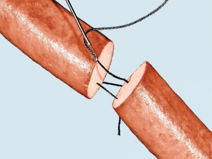 Penis-Scrotum Transplant goes Successful after the guy lost his private parts in the blast | पहली बार Penis-Scrotum का सफल ट्रांसप्लांट, ब्लास्ट में खो दिया था गुप्तांग