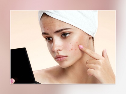 Avoid fast food and caffein to get rid of acne pimples on face in hindi | इन 2 चीजों का सेवन बनता है मुहांसों का कारण, जानिए जरूरी टिप्स