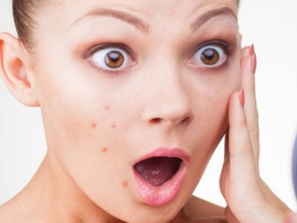 how to handle pimple before the wedding | Skin Care Tips: शादी से पहले चेहरे पर नजर आ रहे मुंहासे? जानिए प्री-वेडिंग ब्रेकआउट को कैसे करें हैंडल