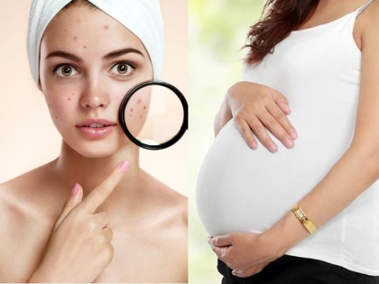 Skin problems post pregnancy pigmentation stretch marks acne home remedies and skin therapy | पिग्मन्टेशन से लेकर स्ट्रेच मार्क्स तक, प्रेग्नेंसी के बाद की इन स्किन प्रॉब्लम को ऐसे करें ठीक