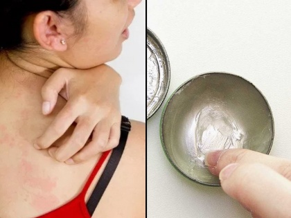 Home remedies to treat rashes on the skin in summers in hindi | गर्मी से होने वाले रैशेज को इन तरीकों से करें 2 दिन में ठीक