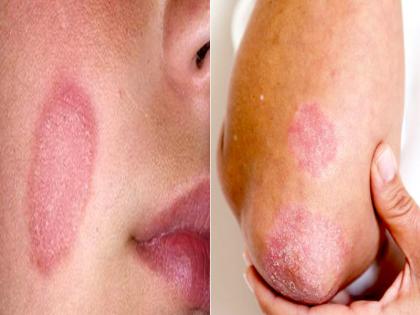 दाद का घरेलू इलाज, अपनाएं ये 6 उपाय, खुजली और स्किन इन्फेक्शन से मिलेगा छुटकारा