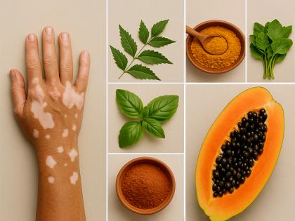 Safed Daag Theek Karne ka Gharelu upay Home Treatment of vitiligo or leucoderma in hindi | सफेद दाग ठीक करने का घरेलू उपाय, अपनाएं ये 6 टिप्स, धीरे-धीरे दिखने लगेगा असर