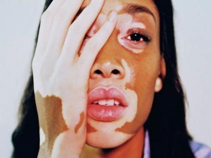 home remedies for leucoderma: use neem to get rid leucoderma or safed daag | सफेद दाग को पूरी तरह खत्म कर देते हैं घर-घर में मिलने वाले इस पेड़ के हरे पत्ते home remedies for leucoderma: use neem to get rid leucoderma or safed daag | सफेद दाग को पूरी तरह खत्म कर देते हैं घर-घर में मिलने वाले इस पेड़ के हरे पत्ते