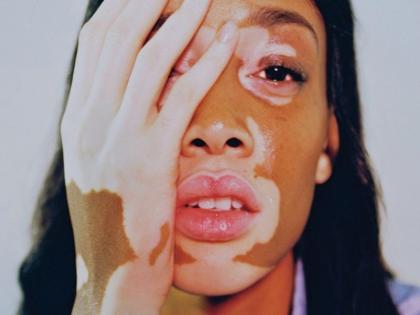 Vitiligo or leucoderma : causes, symptoms, home remedies, treatment, prevention, ayurveda treatment | सफेद दाग कितना बड़े क्यों न हो, जड़ से मिटा सकती हैं ये 3 चीजें, कहीं भी फ्री मिल जाएगी दूसरी चीज