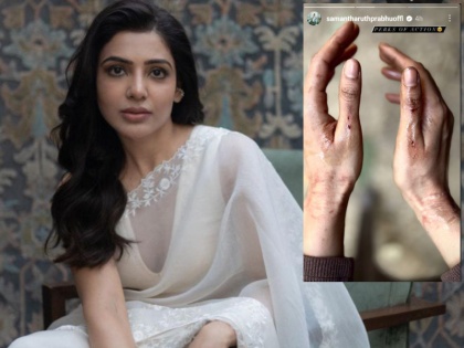 Samantha Ruth Prabhu injured on the sets of Citadel! The actress shared a picture of badly burnt hands | 'सिटाडेल' के सेट पर घायल हुई संमाथा! एक्ट्रेस ने बुरी तरह जले हाथों की तस्वीर की साझा