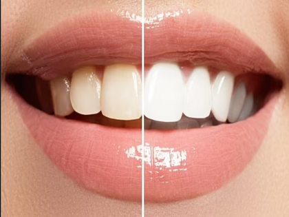 Teeth Whitening Natural Tips Saaf aur safed daant ke gharelu upay remove stains | साफ और चमकदार सफेद दांतों के लिए आजमाएं ये उपाय, पीलेपन की समस्या से निजात मिलेगी