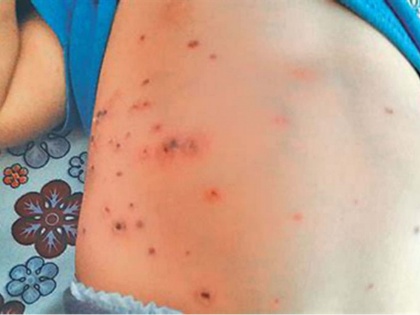 Outbreak of 'scrub typhus' disease in noklak district of Nagaland | नगालैंड के नोकलाक जिले में 'स्क्रब टाइफस' बीमारी का प्रकोप, जानिए क्या होते हैं लक्षण