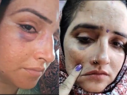 Did Sachin meena assault Seema Haider Injuries seen on face and eyes Pakistani woman herself told the truth | क्या सीमा हैदर के साथ सचिन ने की मारपीट? दिखे चेहरे-आंख पर चोट के निशान, पाकिस्तानी महिला ने खुद बताई सच्चाई