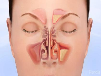 How to Get Rid of a Sinus Infection: signs and symptoms of sinusitis, Home Remedies and medical treatment of sinusitis in Hindi | Sinus Infection का घरेलू इलाज : साइनस इन्फेक्शन के 10 लक्षणों को समझें, राहत पाने के लिए आजमायें 5 घरेलू उपाय