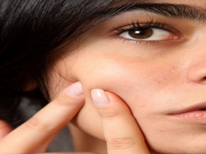 5 simple tips for avoiding acne during monsoon | मानसून के दौरान मुंहासों से बचने में आपकी मदद करेंगे ये 5 सरल टिप्स, आजमाकर देखें