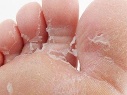 skin peeling treatment: causes of skin peeling, home remedies and home treatment of skin peeling in Hindi | हाथ-पैर की खाल निकलने का इलाज : हाथ-पैरों की स्किन निकलने पर आजमायें 4 आसान घरेलू उपाय