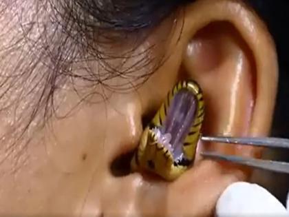 Snake trapped in girl ear doctor engaged in removal got upset watch dangerous viral video | VIDEO: लड़की के कान में घुसा सांप, निकालने में लगे डॉक्टर भी हुए परेशान, देखें खतरनाक वीडियो