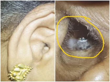 Video: 49-year-old sleeping woman ran to the hospital troubled by spider, itching and pain in her ear and then..... | वीडियो: सो रही 49 साल की महिला की कान में मकड़ी, खुजली और दर्द से परेशान भागी अस्पताल और फिर.....