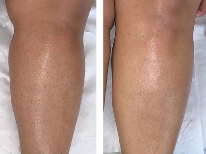 Strawberry Legs Treatment, Symptoms, Causes, home remedies, cream and Laser therapy in Hindi | Strawberry Legs treatment: पैरों पर बालों की जड़ो में दिखने वाले बड़े छिद्रों और काले धब्बों से इन 3 आसान तरीकों से पाएं छुटकारा