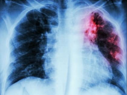 World TB Day 2018: Tuberculosis can affect these parts of your body along with lungs | World TB Day 2018: फेफड़ों के अलावा इन अंगों को चपेट में ले सकता है टीबी