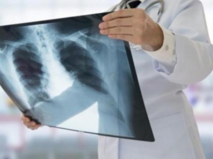 World Tuberculosis Day: how to get rid TB, signs, symptoms and causes of TB, diet plan and prevention tips for TB in Hindi | World Tuberculosis Day: टीबी की बीमारी में शरीर देता है 10 चेतावनी, तुरंत खाना शुरू करें ये 5 चीजें World Tuberculosis Day: how to get rid TB, signs, symptoms and causes of TB, diet plan and prevention tips for TB in Hindi | World Tuberculosis Day: टीबी की बीमारी में शरीर देता है 10 चेतावनी, तुरंत खाना शुरू करें ये 5 चीजें