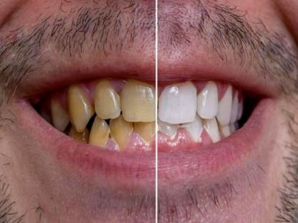 Are you fed up with yellow teeth, then here is the easiest solutions for teeth whitening