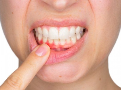 Genes may play role in tooth decay, gum disease: Study | दांत और मसूड़े खराब होने का ये अजीब कारण आपको कर देगा हैरान