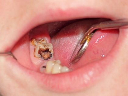 COVID black fungus sign and symptoms: 5 oral related symptoms that could be black fungus | Black Fungus oral related symptoms: दांत और मसूड़ों से जुड़े ये 5 लक्षण हो सकते हैं ब्लैक फंगस की निशानी, समझें और इलाज कराएं