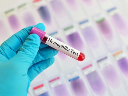 World Haemophilia Day: Causes, Symptoms, and Treatment of this disease | बच्चे को बिना वजह नाक, मुंह और गुदा से खून आता है? उसे हो सकती है यह खतरनाक बीमारी