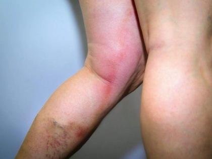 thick blood side effects: causes, symptoms and risk factors of Thick Blood or Hypercoagulability in Hindi | खून गाढ़ा होने के नुकसान : गाढ़ा खून बढ़ा सकता है ब्लड क्लॉट, हार्ट अटैक का खतरा, 8 लक्षणों से करें खून गढ़ा होने की पहचान