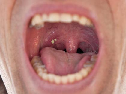 Winter care tips: home remedies for tonsils and sore throat, causes and symptoms | सावधान! जाती हुई ठंड में तेजी से बढ़ रही टॉन्सिल्स, गले की खराश की बीमारी, ये 2 नुस्खे देंगे तुरंत आराम
