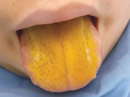 Canada 12 years old boy diagnosed rare disease with bright yellow tongue | 12 साल के बच्चे को हुई अजीब बीमारी, चमकदार पीली जीभ देखकर डॅाक्टर भी रह गए हैरान