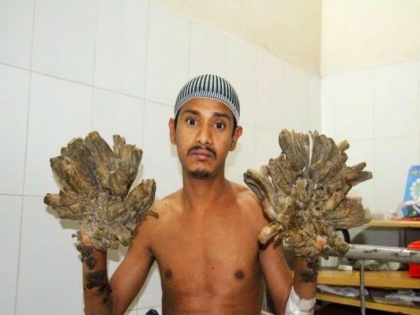 Tree Man of Bangladesh wants hands amputated to relieve pain, know know causes symptoms and treatment of Epidermodysplasia Verruciformis in Hindi | हाथ-पैर पर रोज उग आते हैं पेड़! 'ट्री-मैन' ने कहा-प्लीज मेरे हाथ काट दो, इस बीमारी से हैं पीड़ित