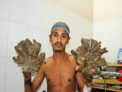 bangladesh tree man back in hospital for surgery, know causes, symptoms and treatment of epidermodysplasia verruciformis | बांग्लादेश के इस आदमी के हाथों पर फिर उगने लगे 'पेड़', जानिए इस त्वचा रोग के कारण, लक्षण, इलाज और बचाव