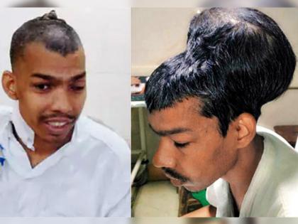doctors remove 1.8 kilo tumor from brain in mumbai | मुंबई में व्यक्ति के सिर से निकाला गया 1.8 किलो का ट्यूमर