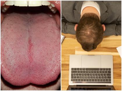 in a man tongue thick black hair grown lingua villosa nigra accidently doctors adviced know full matter | अचानक एक शख्स के जुबान में निकल आए काले-घने बाल, हौरान मरीज ने ली डॉक्टर की सलाह, जानें फिर क्या हुआ