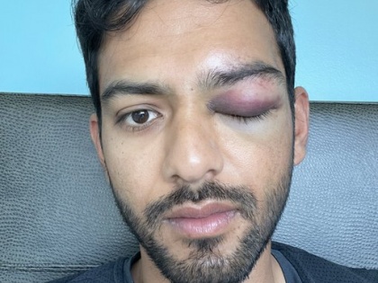 Unmukt Chand captain won world cup serious eye injury shared photo on social media home victorious disappointed possible disaster Play hard but be safe | भारतीय टीम को विश्व कप जिताने वाले कप्तान को आंख में लगी गंभीर चोट, फोटो सोशल मीडिया पर साझा की, ट्वीट कर कहा