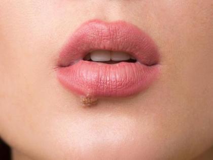 Warts Causes, Symptoms, Risk factors, Medical Treatment, Home remedies, Natural remedies, foods to remove warts, tips for warts in Hindi | न दवा, न दर्द, छोटे-बड़े किसी भी तरह के मस्से को जड़ से खत्म कर देंगी ये 5 खाने की चीजें Warts Causes, Symptoms, Risk factors, Medical Treatment, Home remedies, Natural remedies, foods to remove warts, tips for warts in Hindi | न दवा, न दर्द, छोटे-बड़े किसी भी तरह के मस्से को जड़ से खत्म कर देंगी ये 5 खाने की चीजें