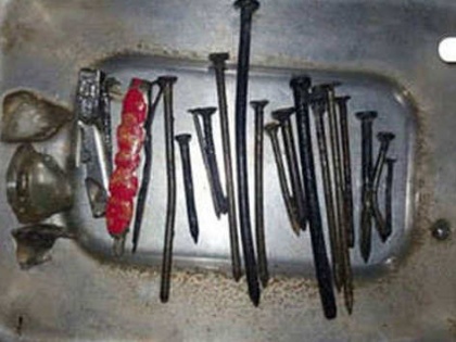 116 iron nails man stomach rajasthan | आफतः उम्र 42 साल, पेट में 116 कील, लोहे के छर्रे और तार का गुच्छा, सर्जरी कर निकाले
