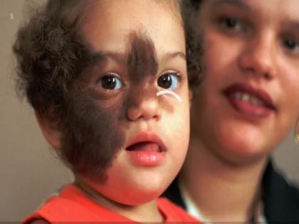 Werewolf Syndrome or Hypertrichosis causes, symptoms, risk factors, medical treatment, prevention tips, symptoms in kids, early symptoms, beauty treatment in Hindi | स्पेन में 17 बच्चों के मुंह पर अचानक उगने लगे लंबे बाल, क्या है ये बीमारी, कारण, लक्षण, उपाय Werewolf Syndrome or Hypertrichosis causes, symptoms, risk factors, medical treatment, prevention tips, symptoms in kids, early symptoms, beauty treatment in Hindi | स्पेन में 17 बच्चों के मुंह पर अचानक उगने लगे लंबे बाल, क्या है ये बीमारी, कारण, लक्षण, उपाय