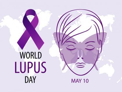 World Lupus Day May 10, 2024 special Get treatment in time Lupus patients can live normal life what is it these are symptoms | World Lupus Day May 10, 2024: समय रहते करा लें इलाज!, ल्यूपस के मरीज जी सकते हैं सामान्य जीवन, आखिर क्या है, ये है लक्षण 