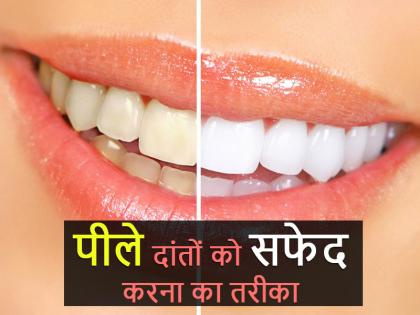 World Oral Health Day: Effective tips to whiten your teeth in 60 seconds | World Oral Health Day- 60 सेकंड में इस आसान उपाय से पाएं मोती जैसे सफेद दांत