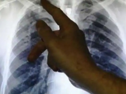 Fearing Tuberculosis, woman found condom stuck in her lung | महिला खांसी को टीबी समझ डॉक्टर के पास दिखाने गई, फेफड़े में फंसा मिला कंडोम, शर्माते हुए बताई ये बात