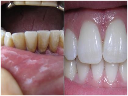 Rubbing orange peel in the teeth gives many benefits effect is visible in a pinch get white shiny healthy teeth health tips in hindi | संतरे के छिलके को दांतों में रगड़ने से मिलता है बहुत फायदा, चुटकियों में दिखने लगता है असर, मिलते है सफेद, चमकदार और स्वस्थ तीथ