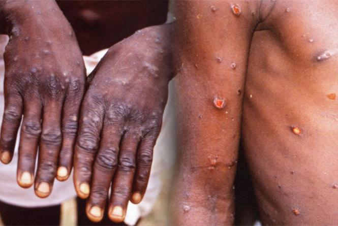 Early Symptoms of Monkeypox Virus know how monkeypox infection spreads | early-symptoms-of-monkeypox-virus-know-how-monkeypox-infection-spreads | Latest health Photos at Lokmatnews.in