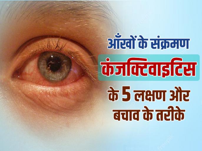 Eye Flu Treatment symptoms precautions and home remedies Eye Flu इंफेक्शन कंजक्टिवाइटिस के 5