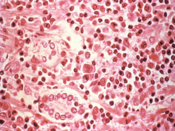 Hantavirus or Orthohantavirus causes, signs and symptoms, risk factors, prevention tips, medical treatment and diagnosis in Hindi | अब चीन में मिला कोरोना वायरस से ज्यादा खतरनाक 'हंता वायरस' (Hantaviruses), जानें कारण, लक्षण, बचाव, इलाज Hantavirus or Orthohantavirus causes, signs and symptoms, risk factors, prevention tips, medical treatment and diagnosis in Hindi | अब चीन में मिला कोरोना वायरस से ज्यादा खतरनाक 'हंता वायरस' (Hantaviruses), जानें कारण, लक्षण, बचाव, इलाज