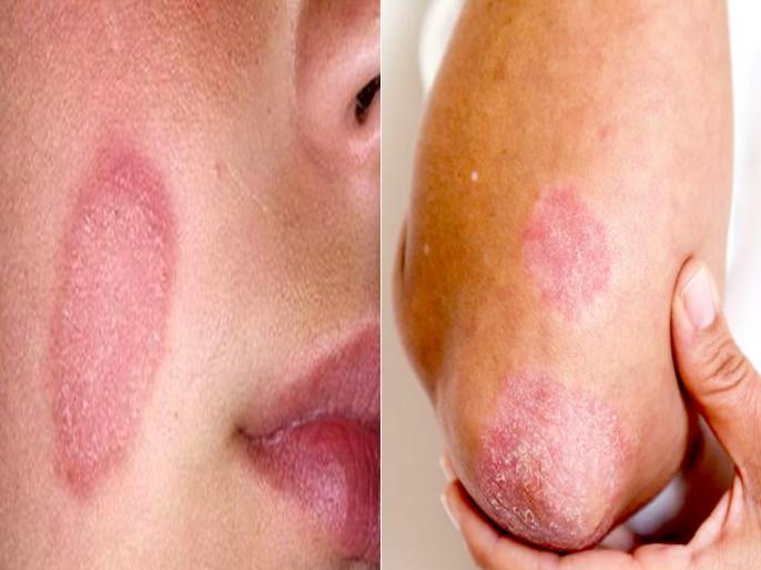 Daad Skin Problem daad ka ilaj get rid ringworm fungal infection | दाद, खाज और खुजली का ...