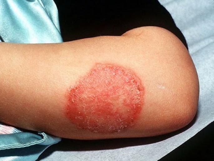 Daad Skin Problem Remedies to get rid of skin allergy, apply these 5 things to get rid of ...